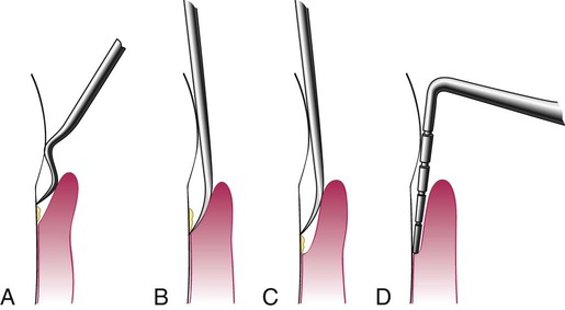 46 Scaling And Root Planing Pocket Dentistry