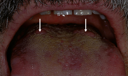 vestibular papillomatosis on tongue