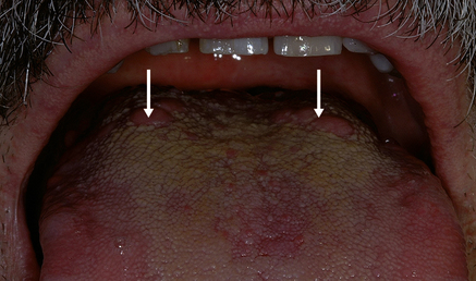 inflamed circumvallate papillae