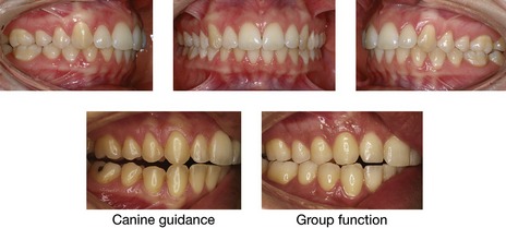 Angle's classification: Class II, Division 2, Introduction to dental  occlusion, Dental Anatomy, , Learn anatomy