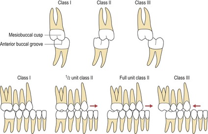 Classification of malocclusion