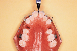 Archwire Shift  Pocket Dentistry