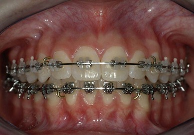 Chapter 1 Low friction esthetic brackets The Clarity   SL 