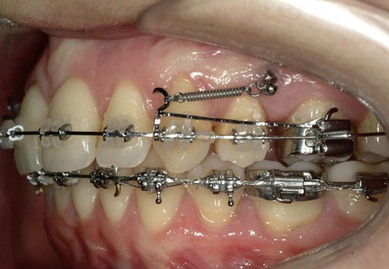 Chapter 1: Low-friction esthetic brackets: The Clarity™ SL Self-Ligating  Appliance System