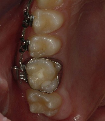 second molar fig pocketdentistry