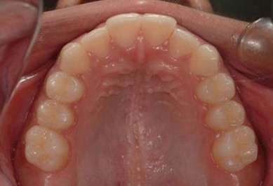 second molar molars fig pocketdentistry