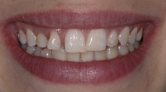 16: COMPLEX IMPLANT RESTORATIVE THERAPY | Pocket Dentistry