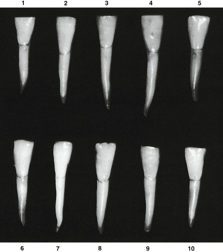 7: The Permanent Mandibular Incisors | Pocket Dentistry