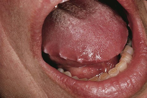hyperkeratosis tongue focal lesions habit thrusting figure related pocketdentistry