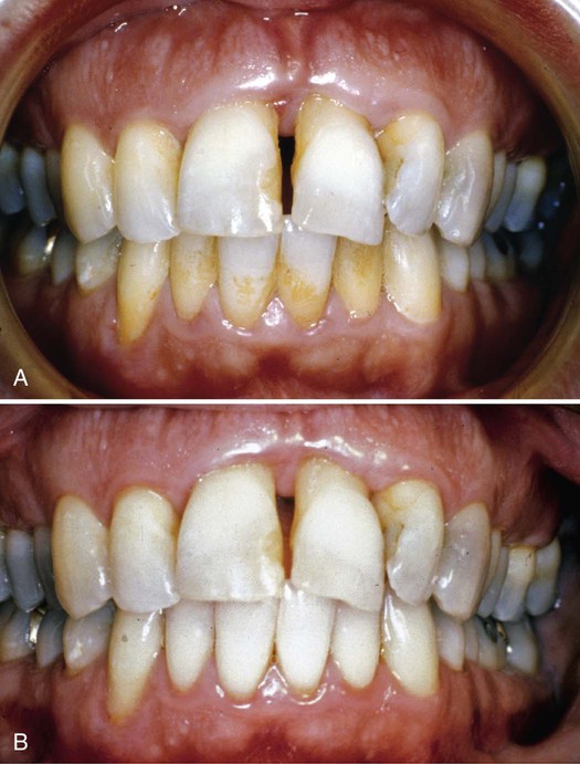 before and after dental calculus remover