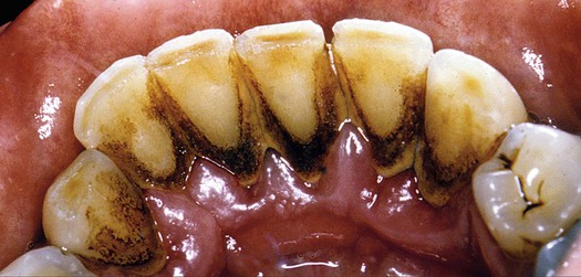 brown spots on teeth near gums