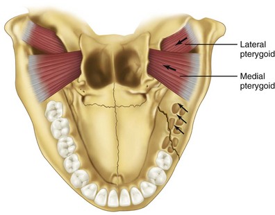 14: Mandibular Fractures | Pocket Dentistry