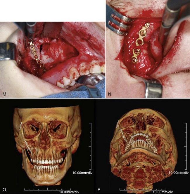 16: Fractures of the Zygomatic Complex and Arch | Pocket Dentistry