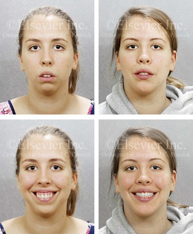 long face syndrome profile