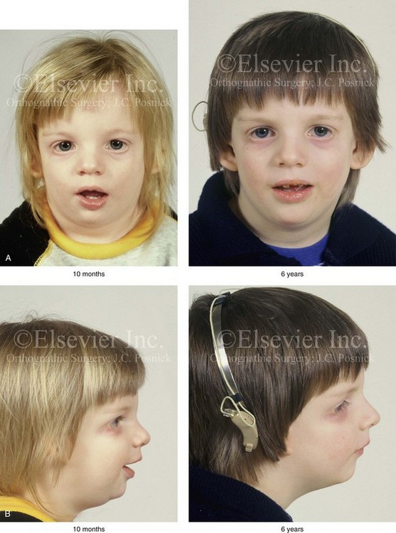 Treacher Collins Syndrome Before And After