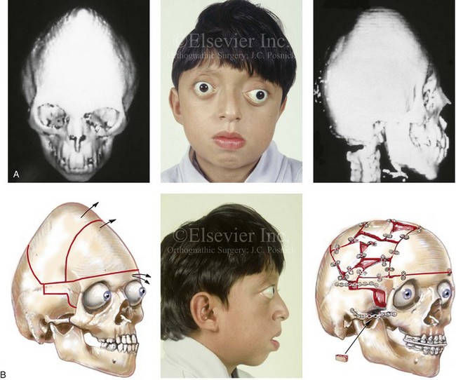 Aesthetic Skull Reshaping