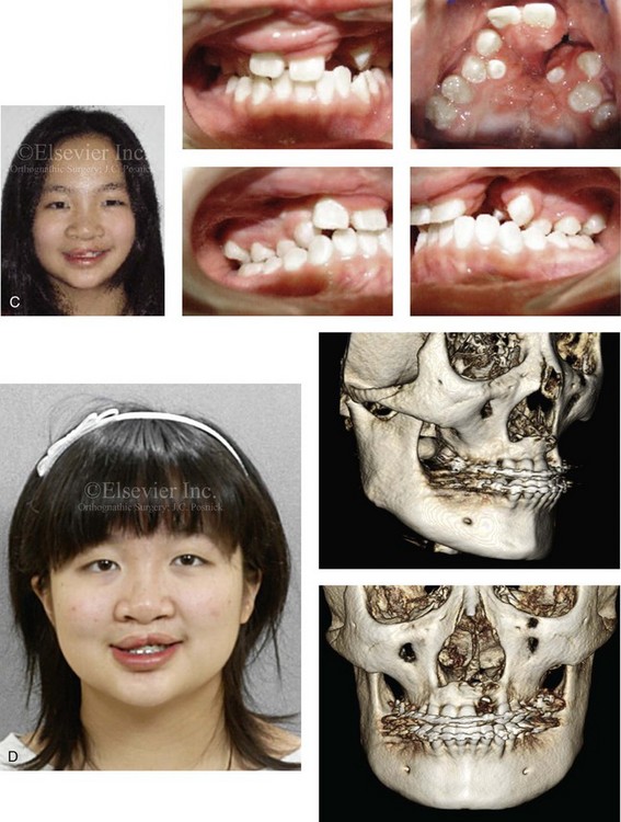 cleft lip and palate adults