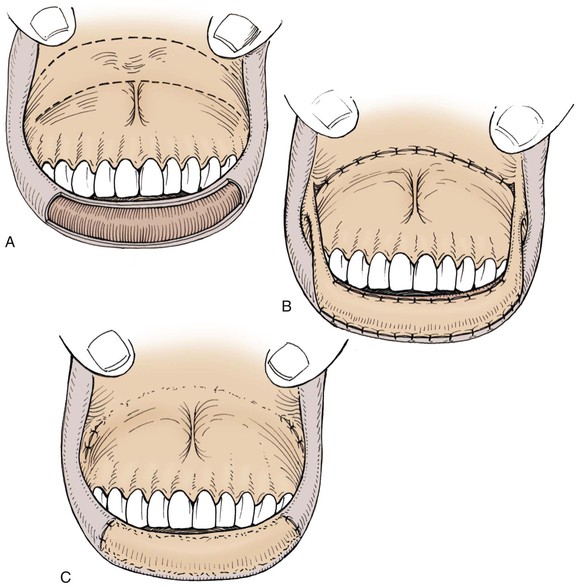 19: Reconstruction of the Lips | Pocket Dentistry