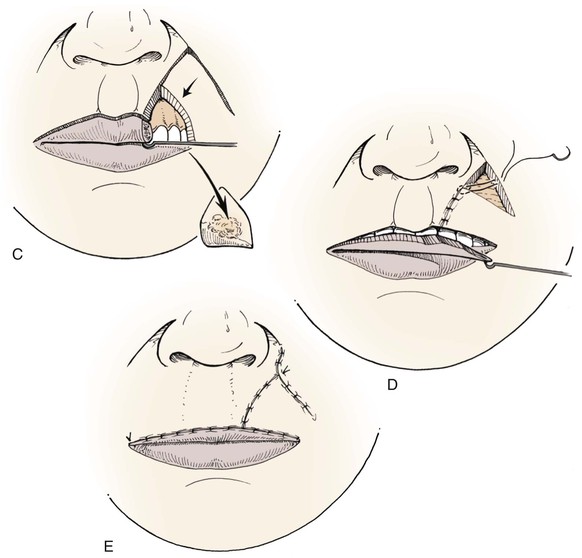 19: Reconstruction of the Lips | Pocket Dentistry