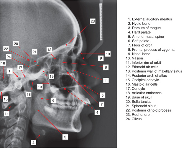 Lateral Cephalometric Radiograph Lateral Cephalometric Radiograph