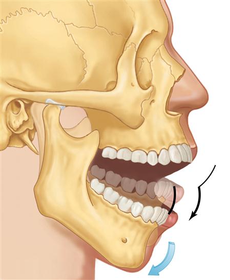 lower jaw condyle