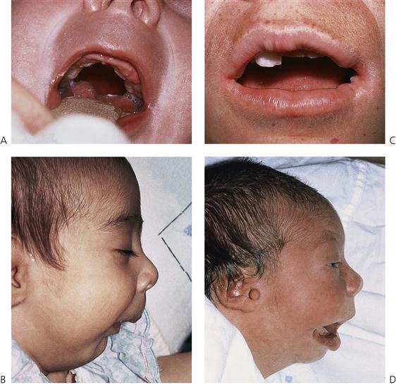 cleft lip and alveolus