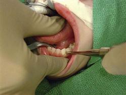 Periotomes In Oral Surgery 6
