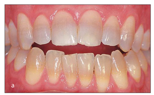 tetracycline teeth staining in adults