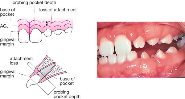 Deep pocket depths (≥ 7mm), bleeding on probing on mesial aspect