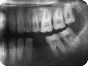 amelogenesis imperfecta radiograph