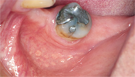 White Patches On Lips Cancer - Infoupdate.org