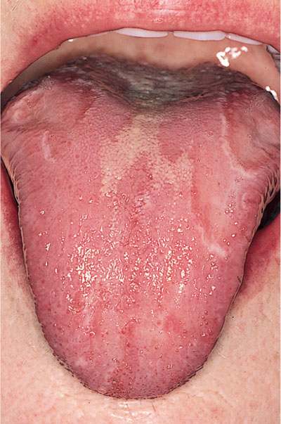 fordyce spots on tongue