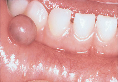 cysts lip mucocele lower management fig child three year old pocketdentistry