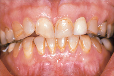 teeth are translucent and stained