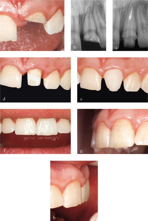 Crowning Root Canal Treated Teeth Pocket Dentistry