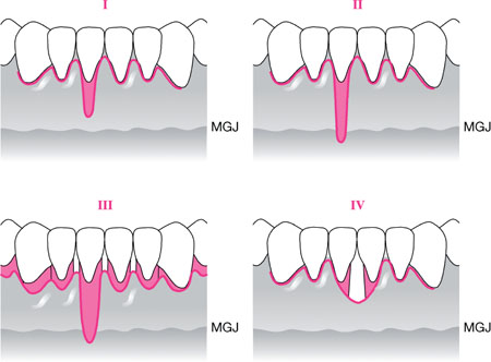 classification des récessions gingivales