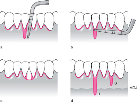 classification des récessions gingivales