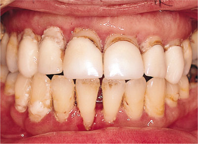 All About Gum and Jaw Recession - Dr Jamilian