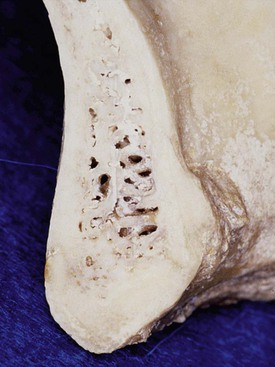 11 Bone Density | Pocket Dentistry
