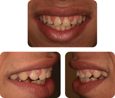 EFFECT OF GINGIVECTOMY ON MEAN EXPOSED LINGUAL OR PALATAL ROOT SURFACE