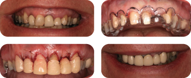 EFFECT OF GINGIVECTOMY ON MEAN EXPOSED LINGUAL OR PALATAL ROOT SURFACE