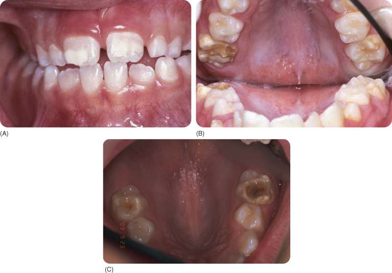 3 Developmental Structural Anomalies of Enamel and Dentine Pocket