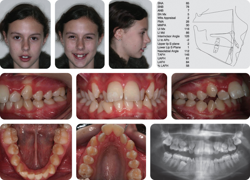 Class 2 Division 1 Malocclusion Features