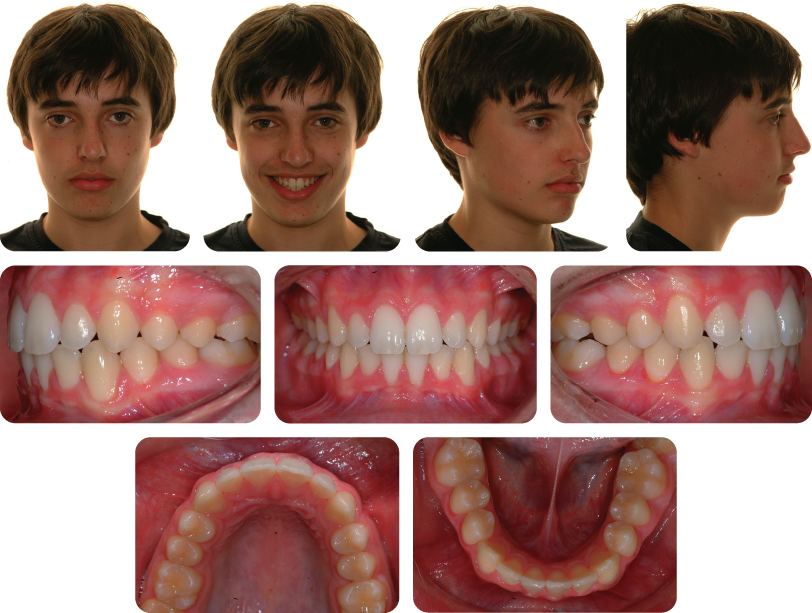4 Class Ii Division 1 Malocclusion Pocket Dentistry