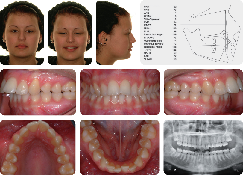 a to d This patient's Class II Division 2 malocclusion was