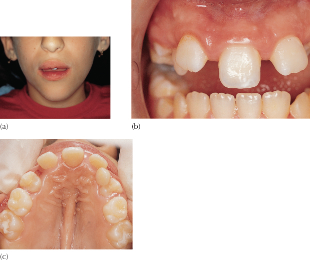 5 Maxillary Central Incisors Pocket Dentistry