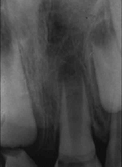 5 Management of Teeth with Necrotic Pulps and Open Apices Pocket