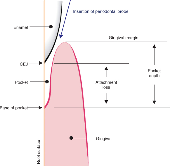 Deep pocket depths (≥ 7mm), bleeding on probing on mesial aspect