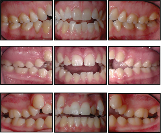 6 Ways To Tell If Your Bite Is Incorrect - Wilkinson Orthodontics