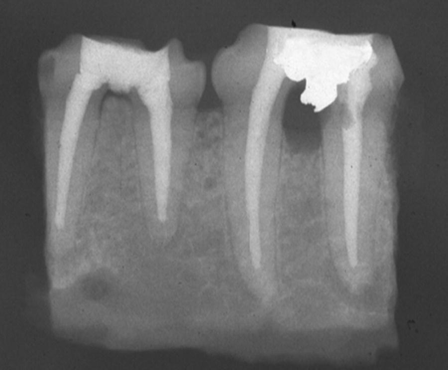 What Is A Perforated Root Canal At Tayla Hunter Blog